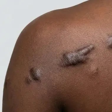 ARSA - Keloids - Banner (1)