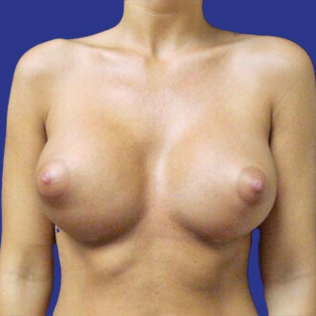 Breast Augmentation 3 Front After