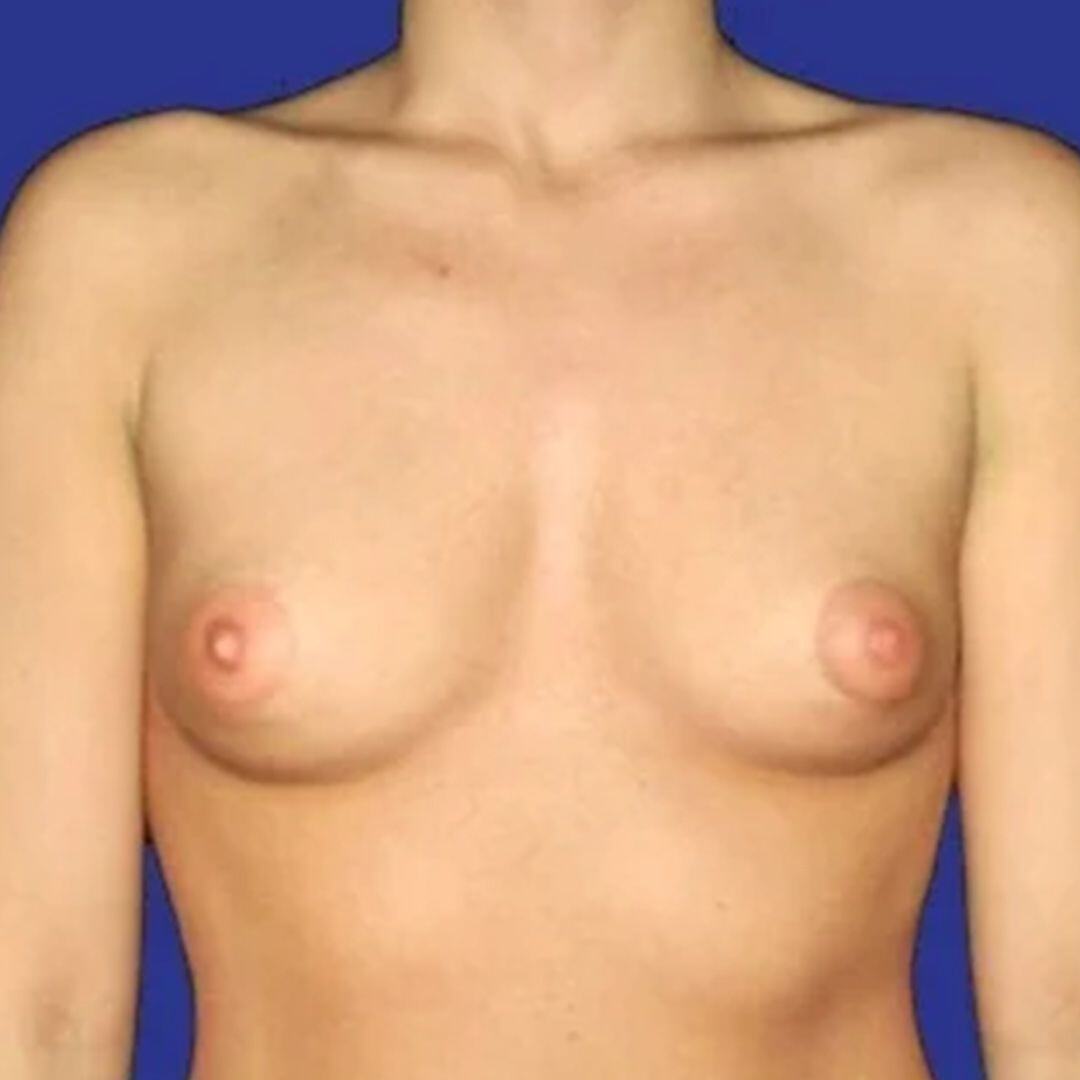 Breast Augmentation 3 Front Before