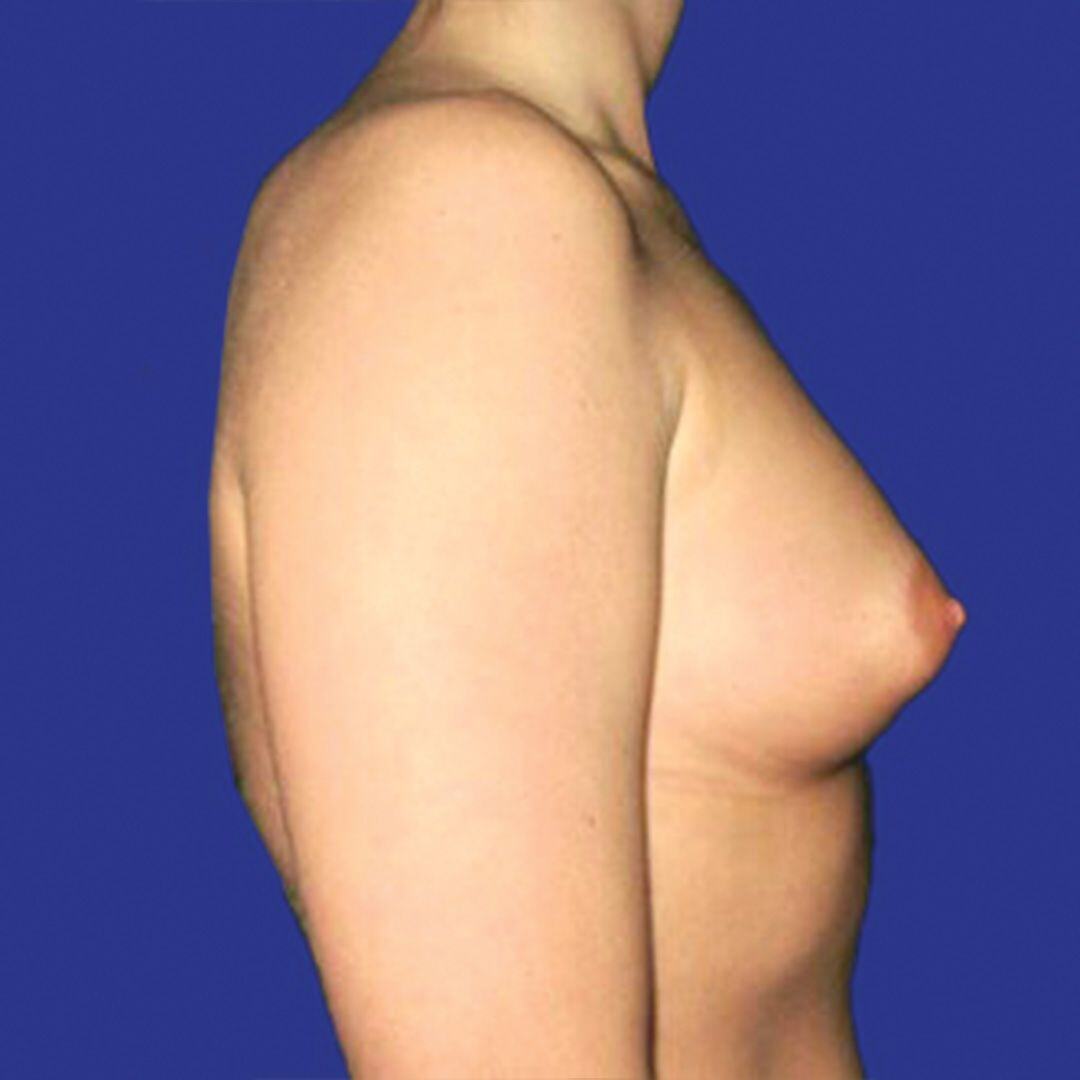 Breast Augmentation 3 Side Before