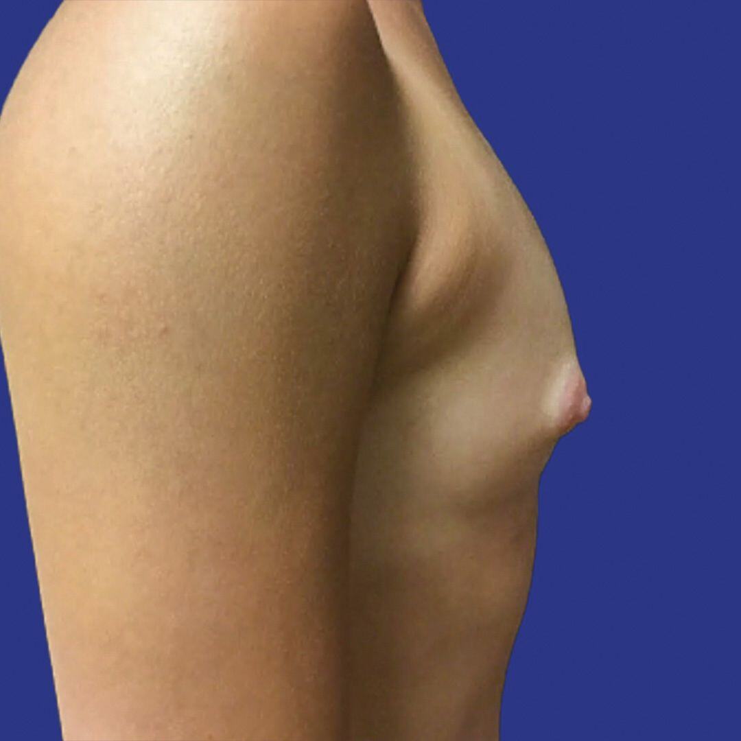 Breast Augmentation 4 Side Before