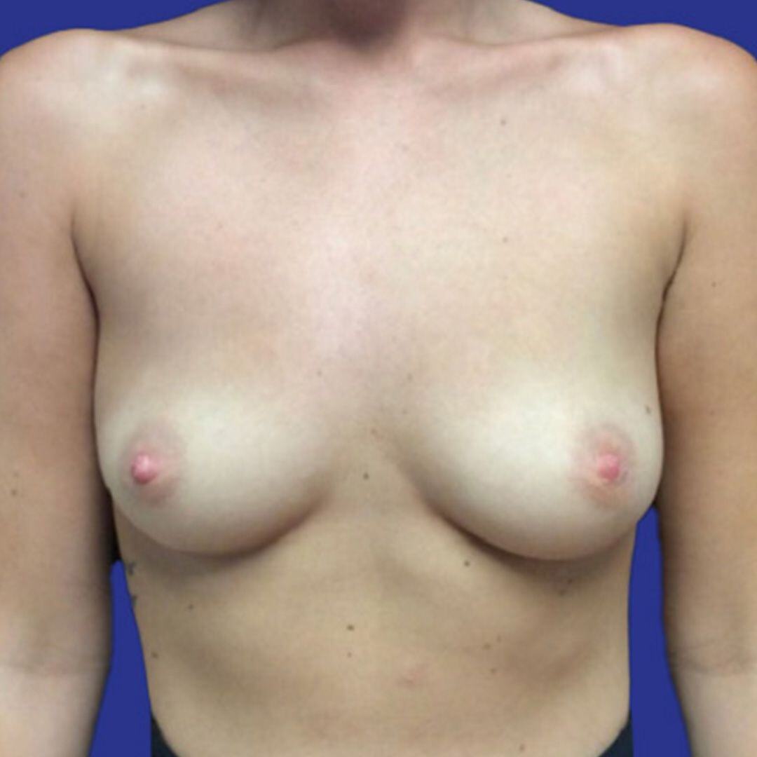 Breast Augmentation 5 Front Before