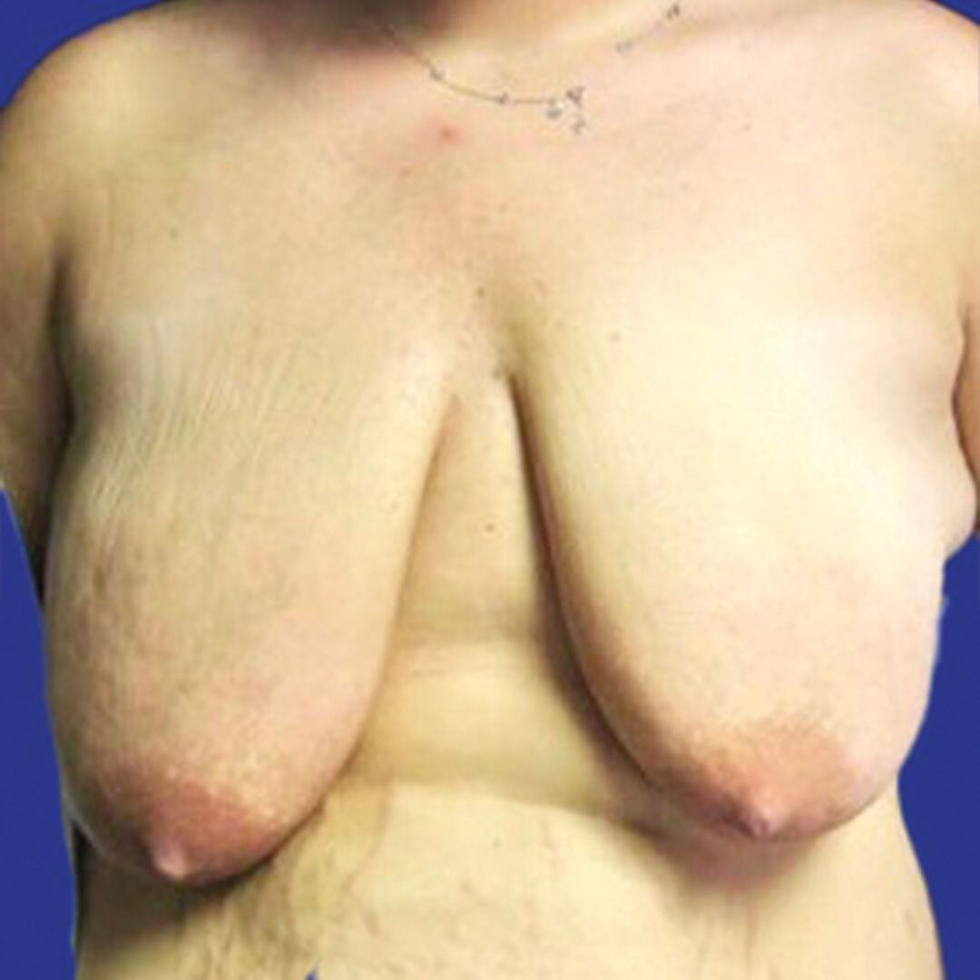 Breast Lift 1 Front Before