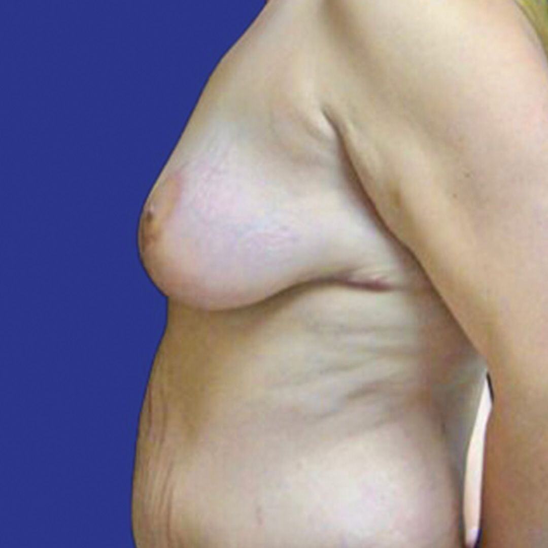 Breast Lift 1 Side After