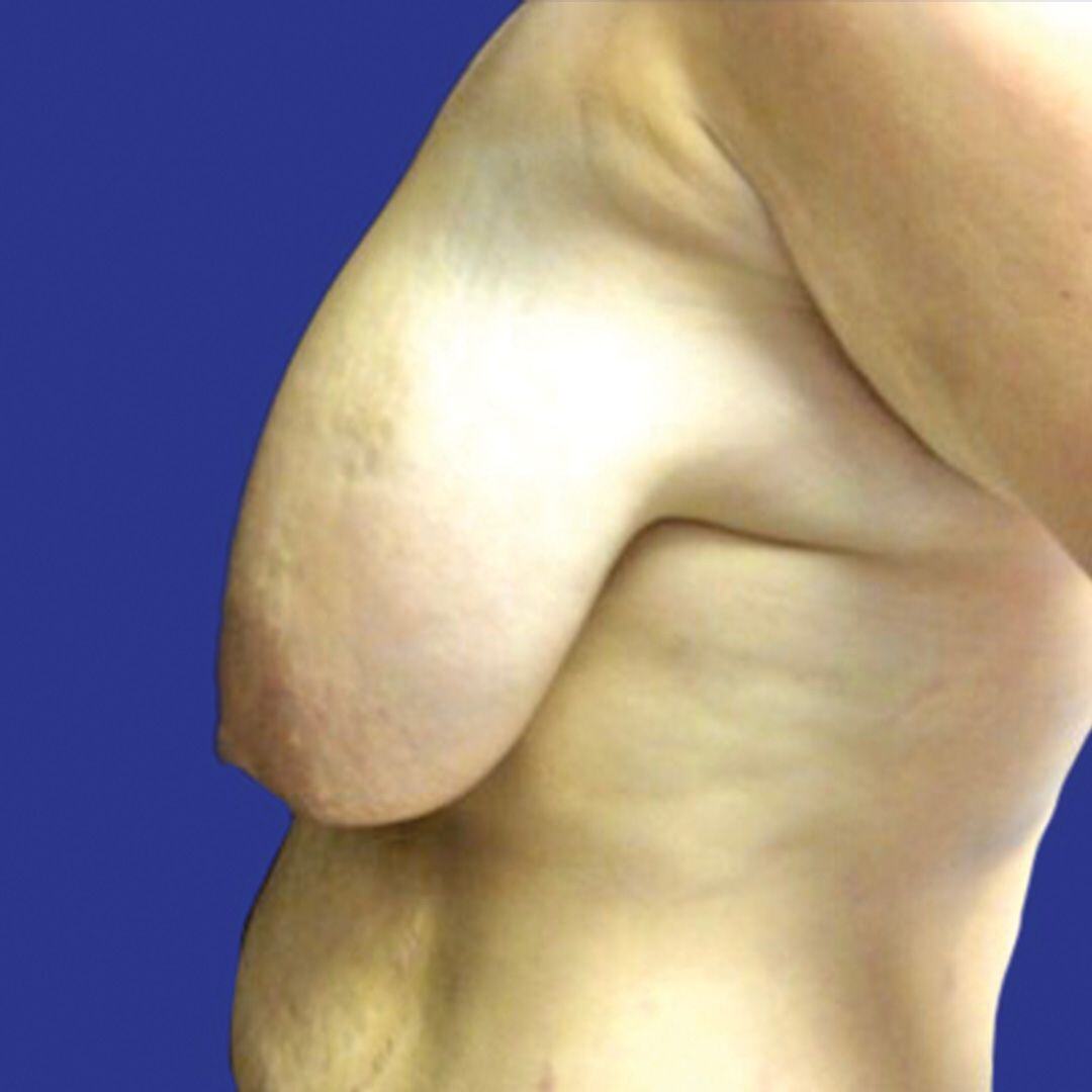 Breast Lift 1 Side Before