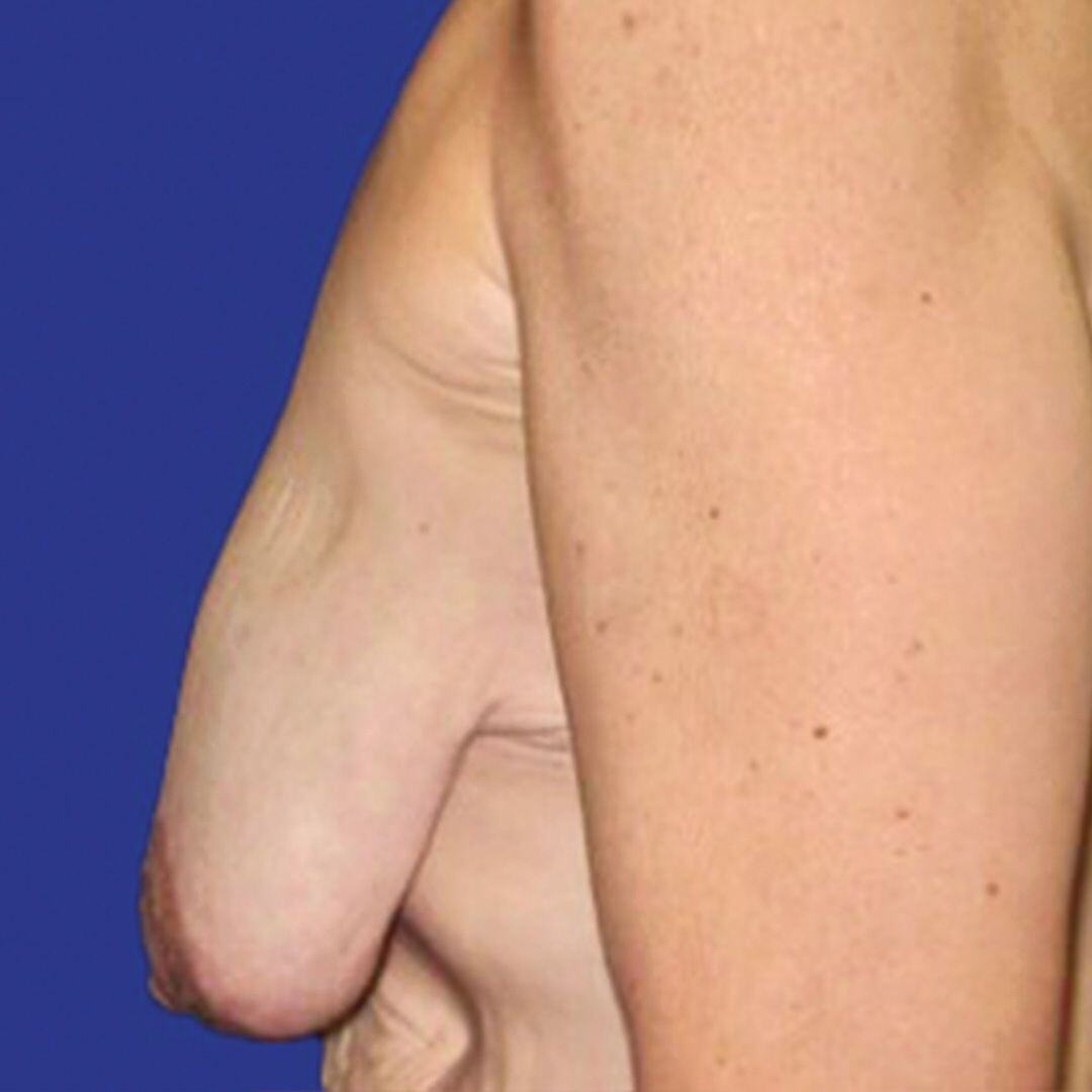 Breast Lift 3 Side After