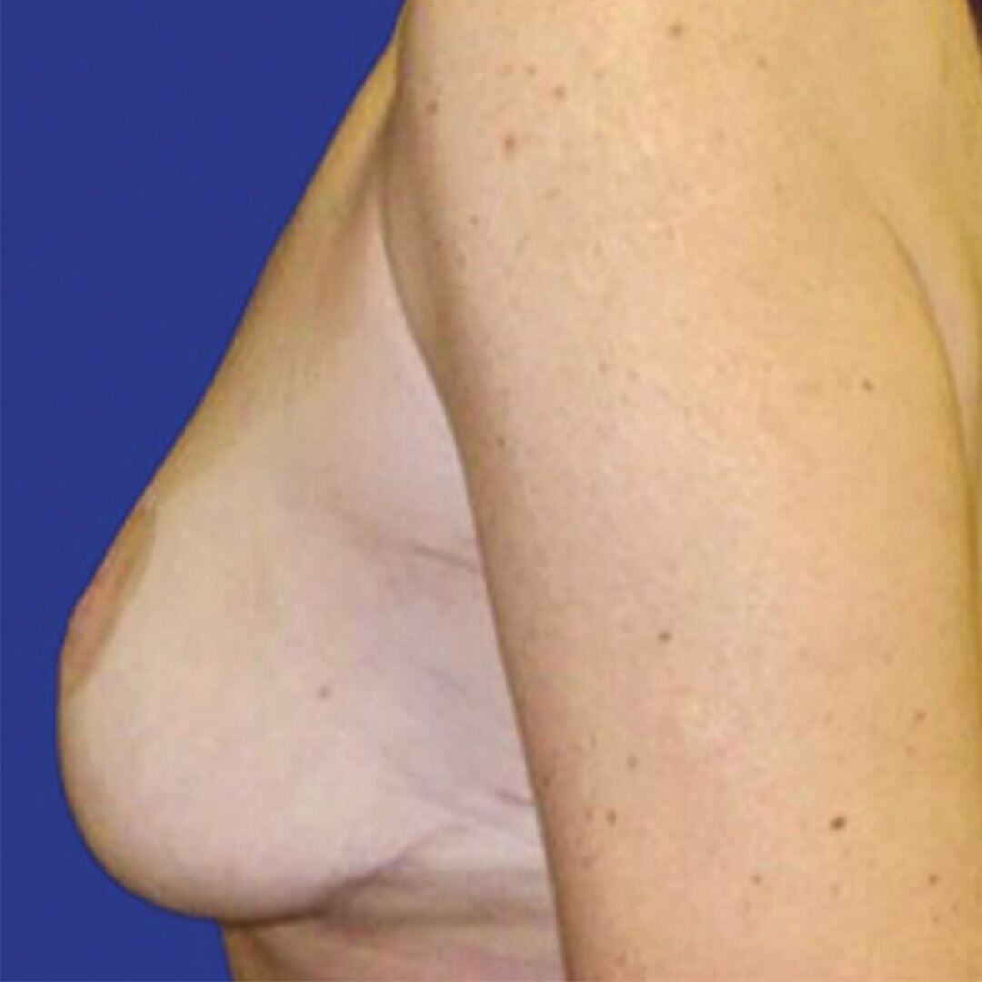 Breast Lift 3 Side Before