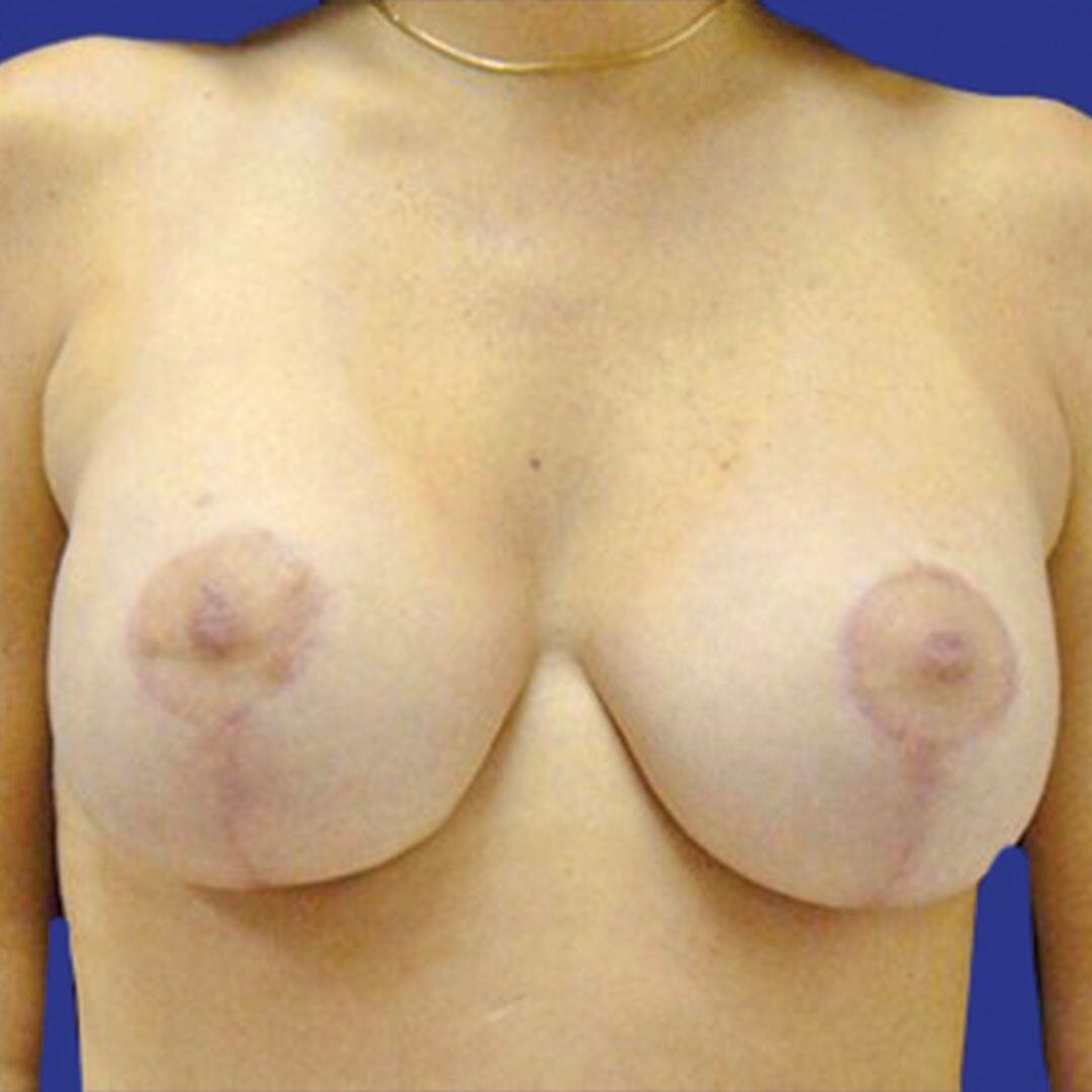 Breast Lift 4 Front After