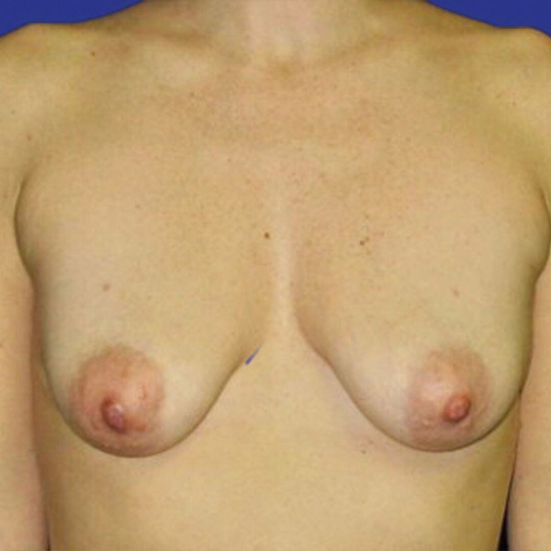 Breast Lift 4 Front Before
