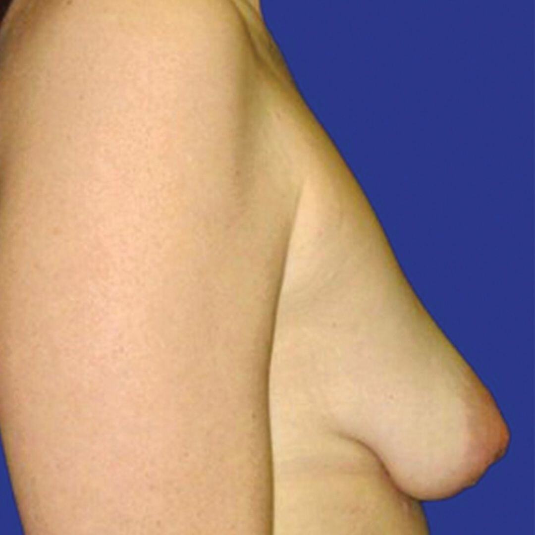 Breast Lift 4 Side Before