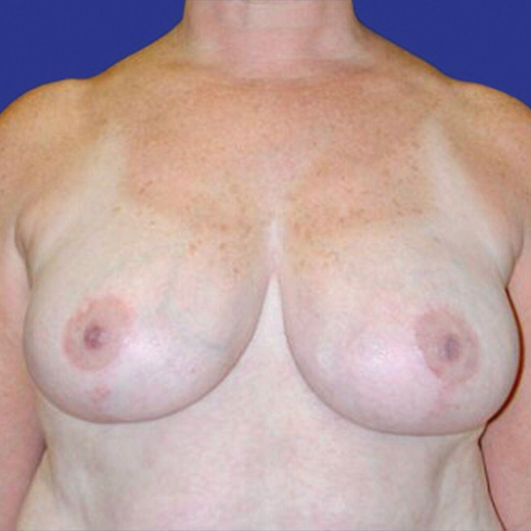 Breast Reduction 2 Front After