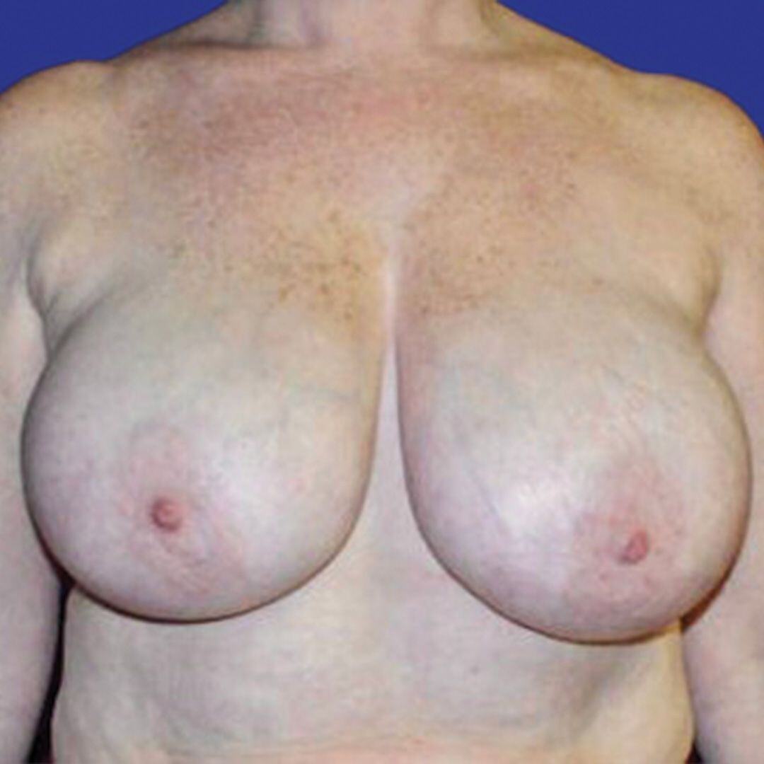 Breast Reduction 2 Front Before