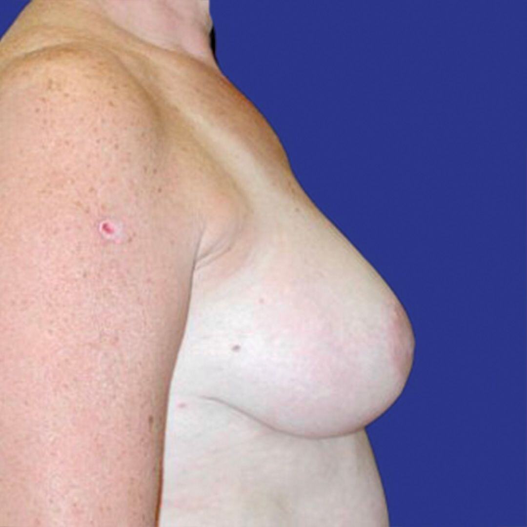 Breast Reduction 2 Side After