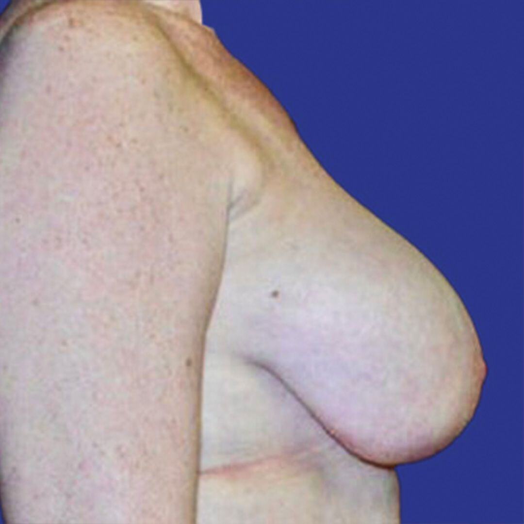 Breast Reduction 2 Side Before