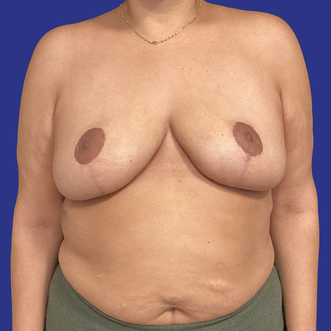 Case 1 - Herman - Breast Reduction - 2