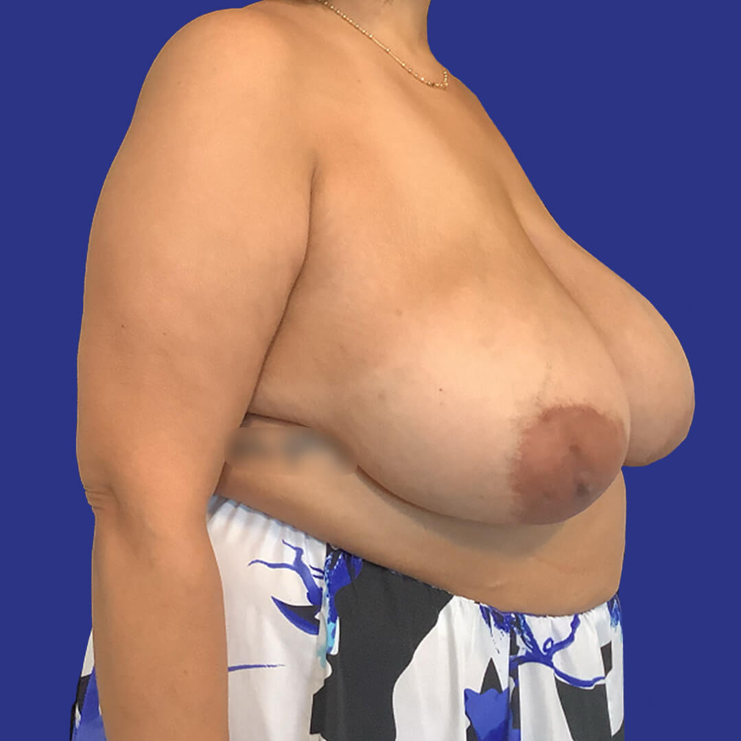 Case 1 - Herman - Breast Reduction - 3