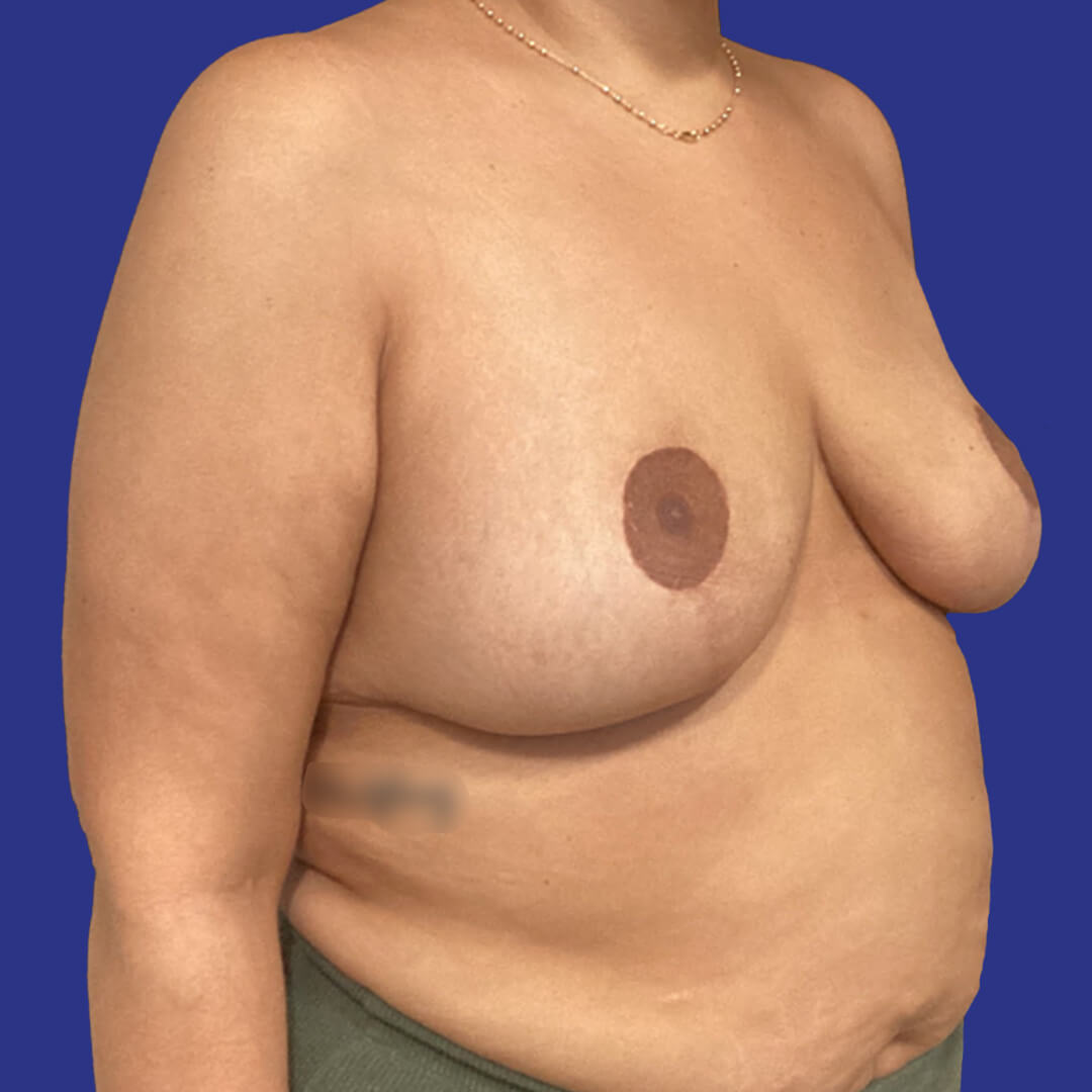 Case 1 - Herman - Breast Reduction - 4