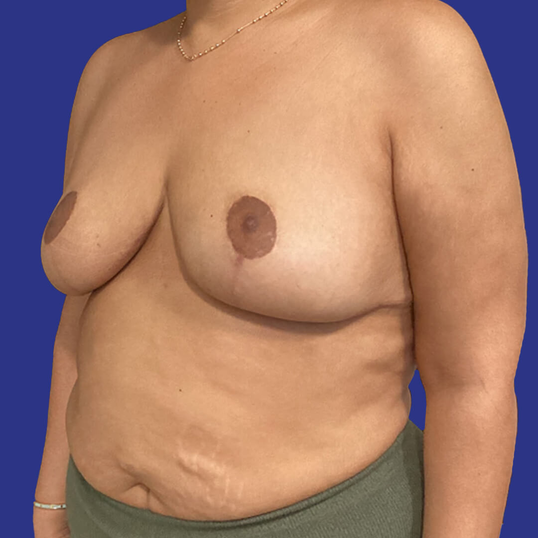 Case 1 - Herman - Breast Reduction - 6