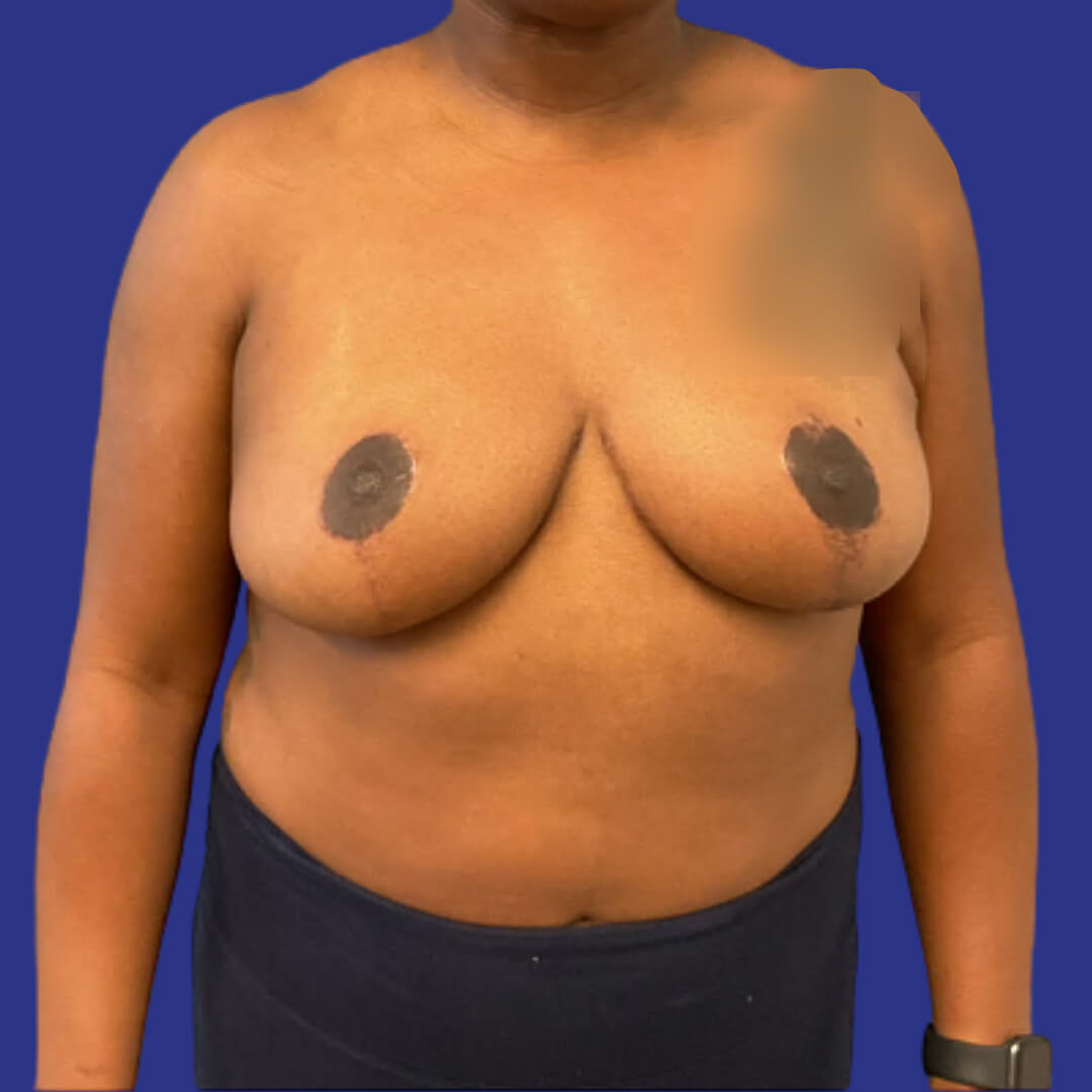 Breast Reduction (After 1)