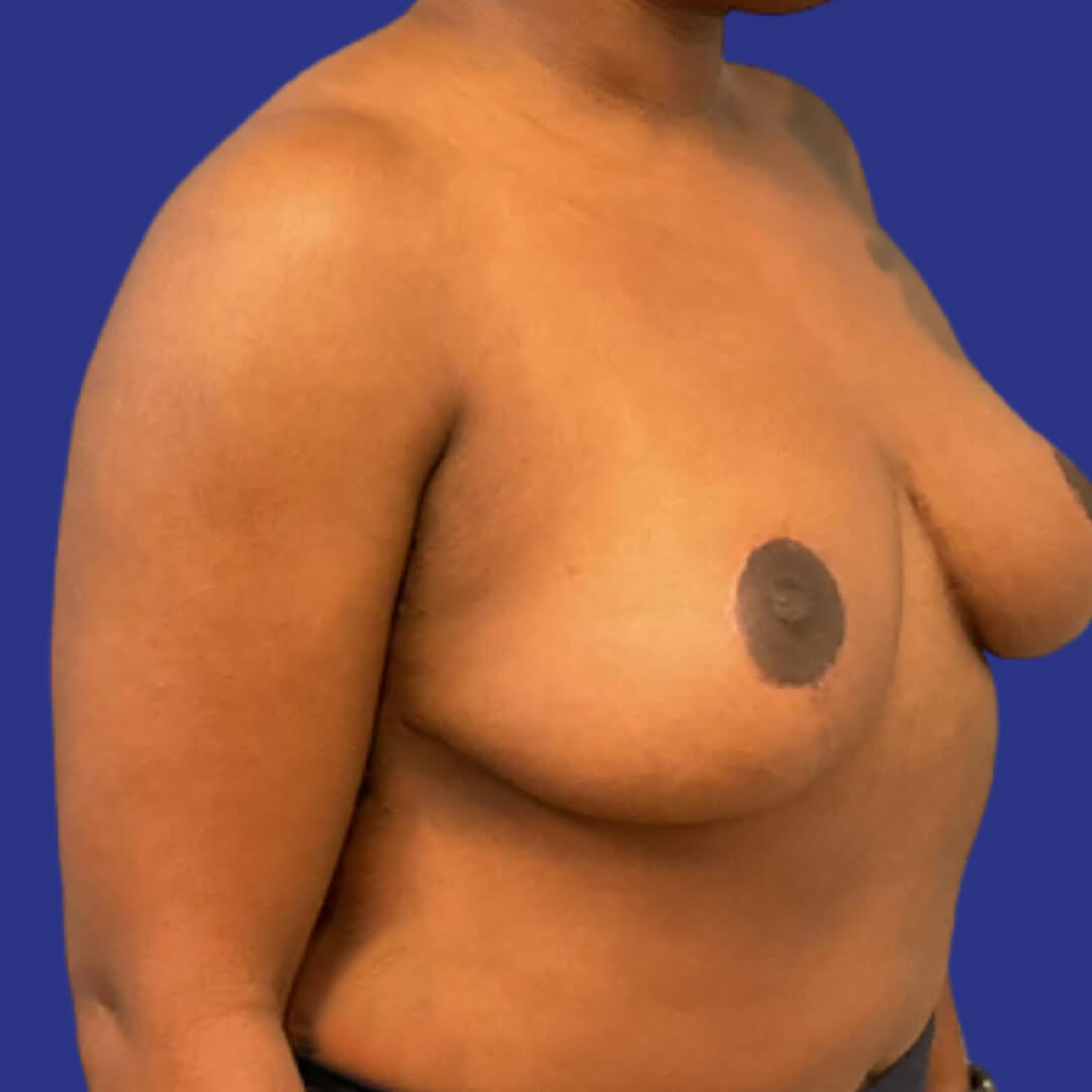 Breast Reduction (After 2)