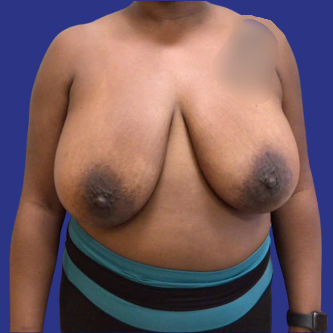 Breast Reduction (Before 1)
