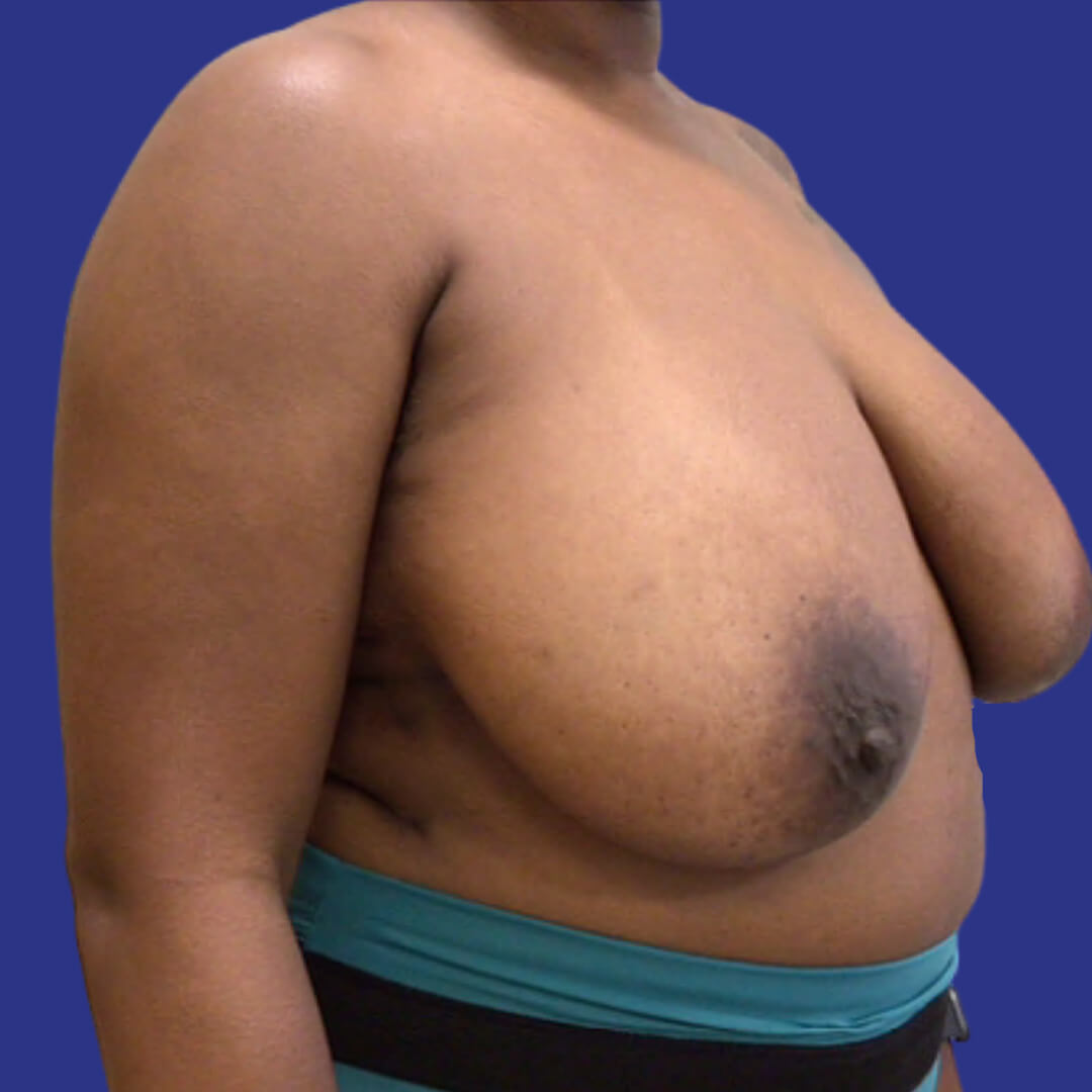 Breast Reduction (Before 2)