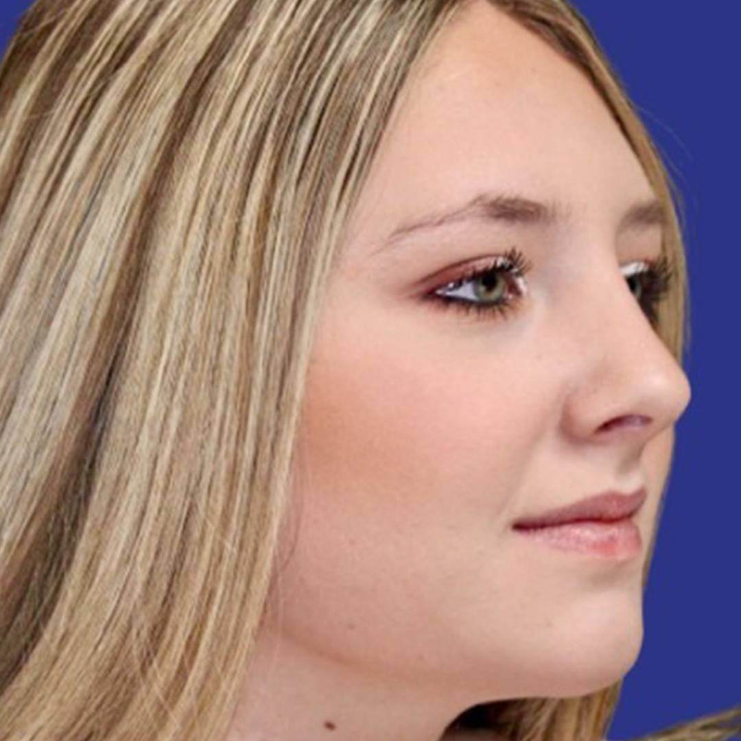 Rhinoplasty 1 after