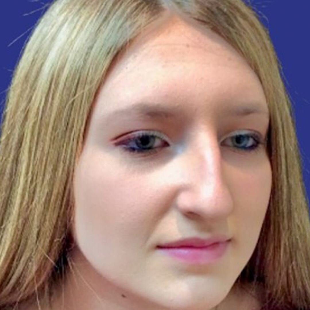 Rhinoplasty 1 before