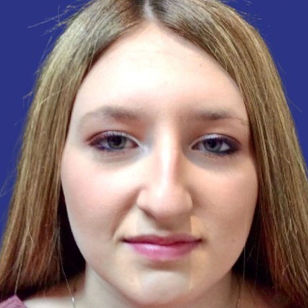 Rhinoplasty 1 front view before