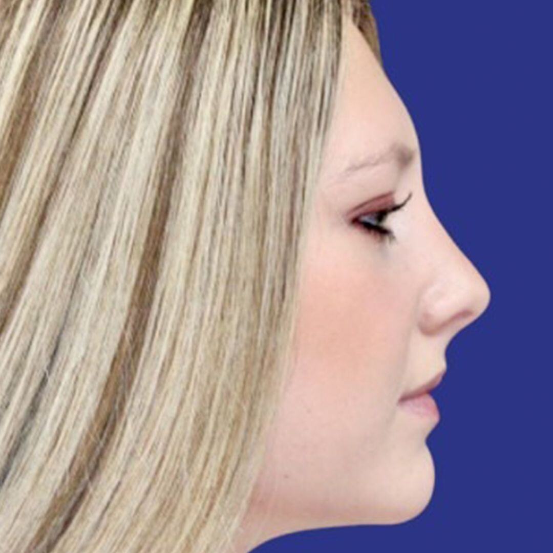 Rhinoplasty 1 lateral view after
