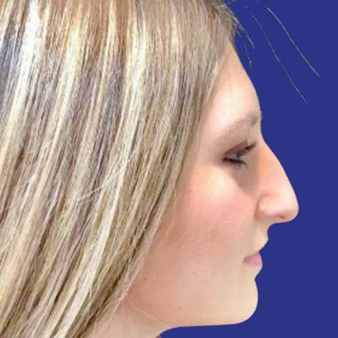 Rhinoplasty 1 lateral view before