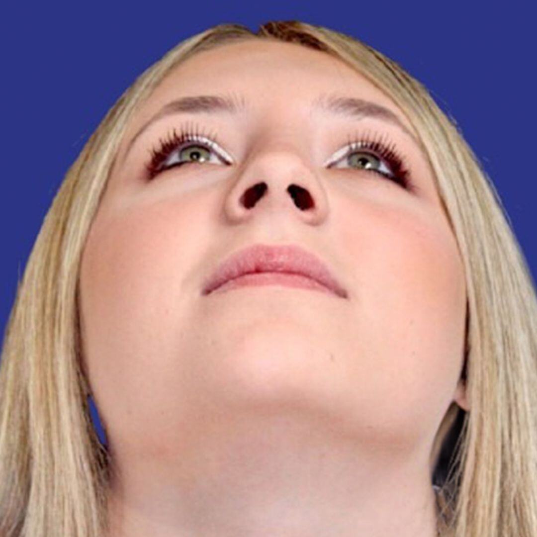 Rhinoplasty 1 up view after