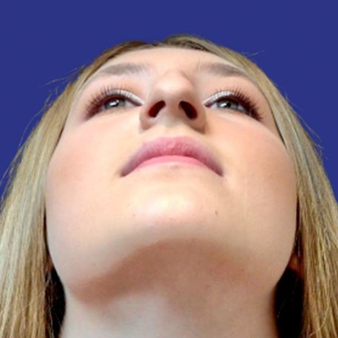 Rhinoplasty 1 up view before