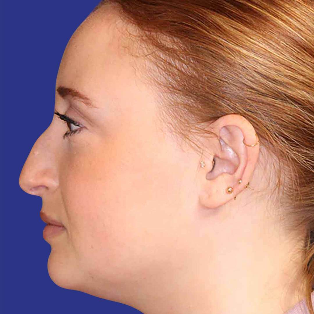 Rhinoplasty 2 -Before-L Profile