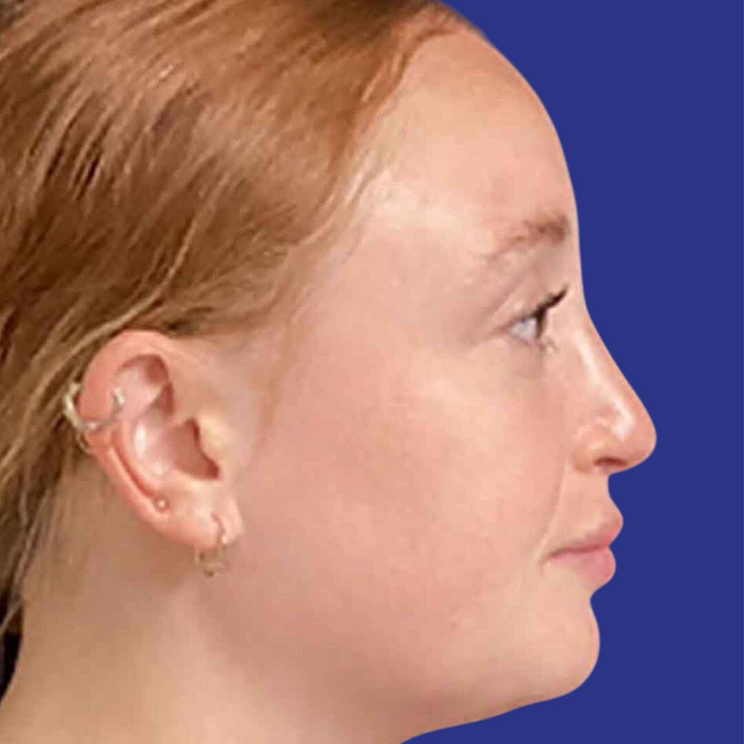 Rhinoplasty 2-After- R Profile