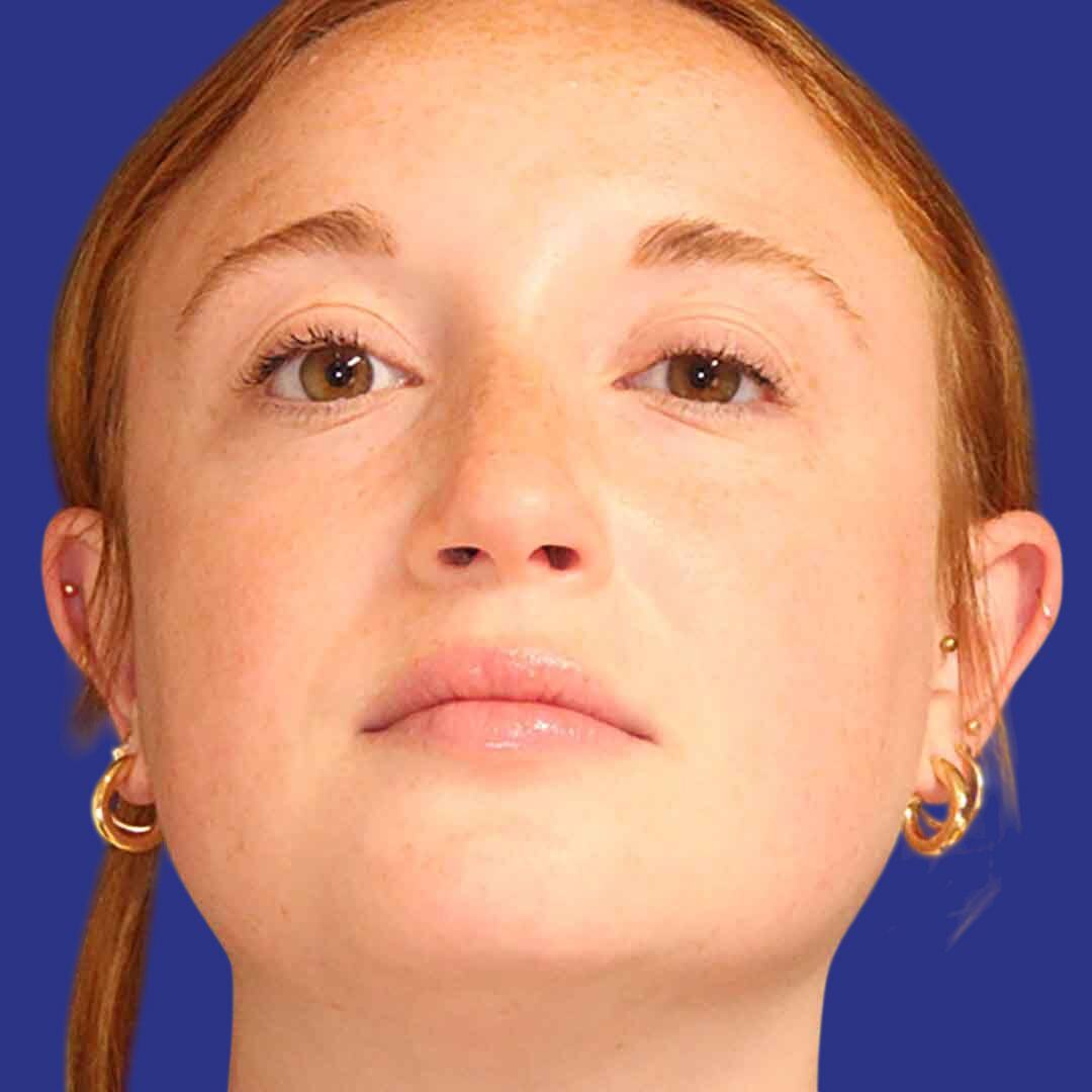 Rhinoplasty 2-After-Front Up