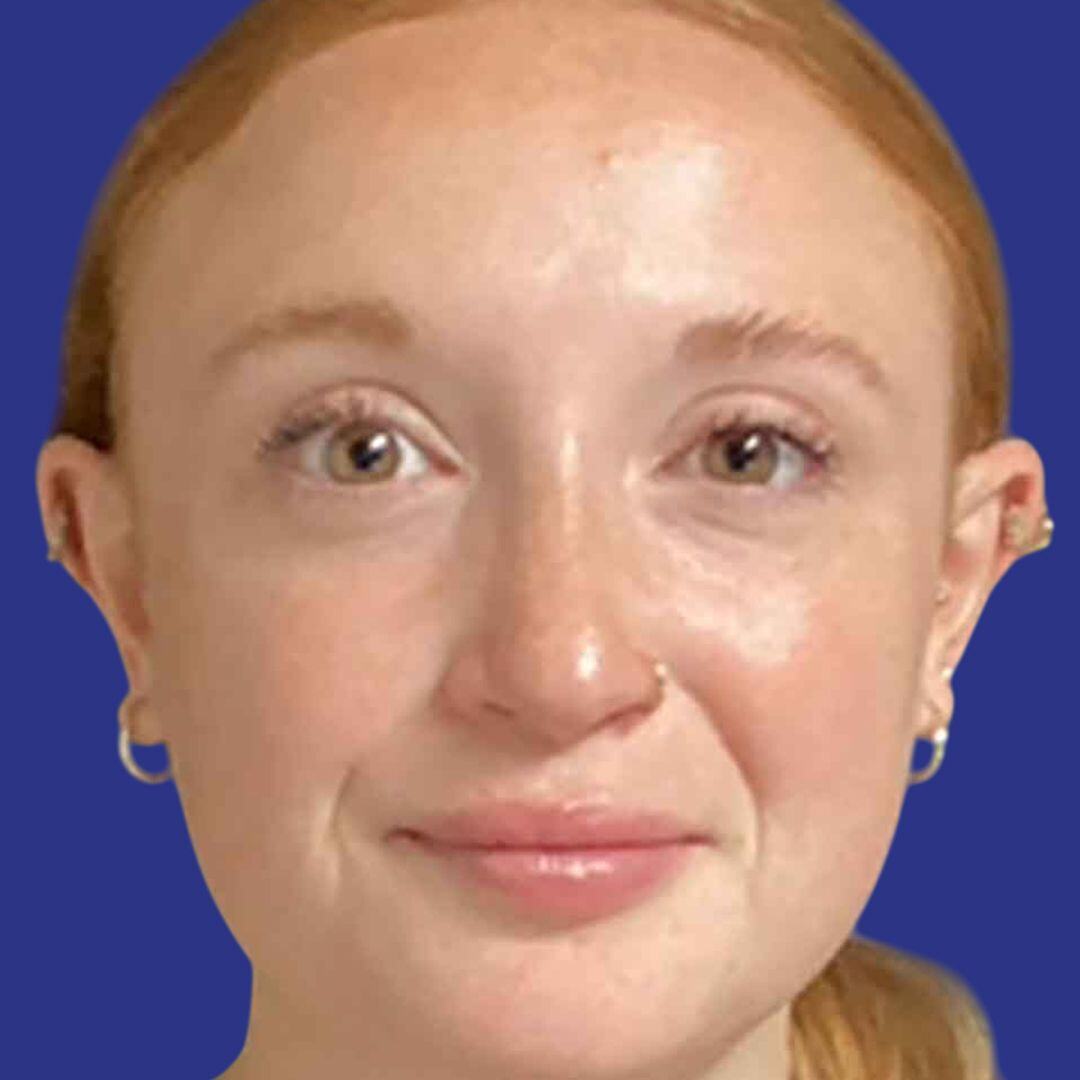 Rhinoplasty 2-After-Front