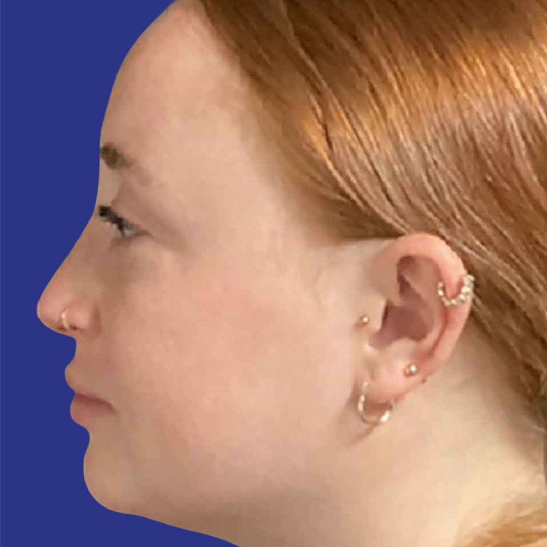 Rhinoplasty 2-After-L Profile