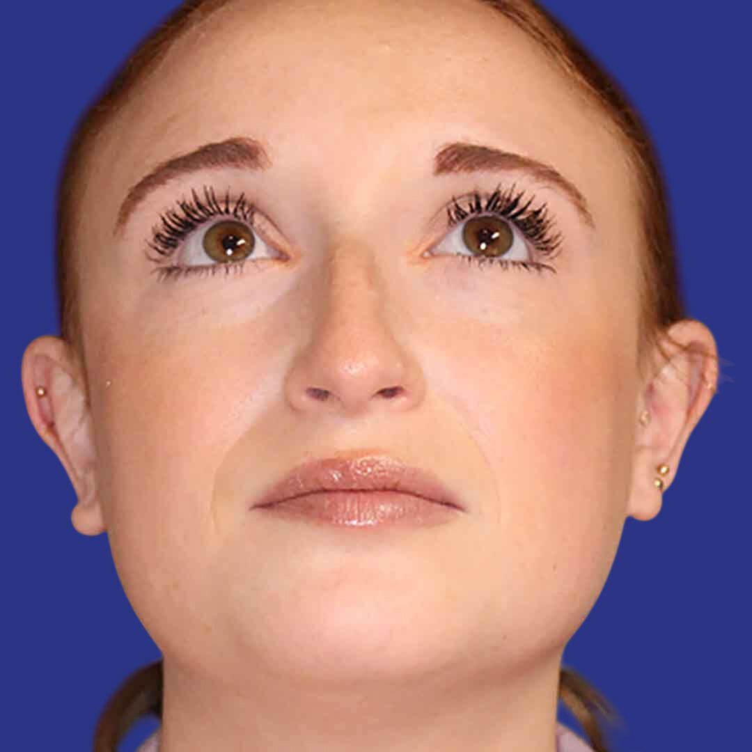 Rhinoplasty 2-Before-Front Up