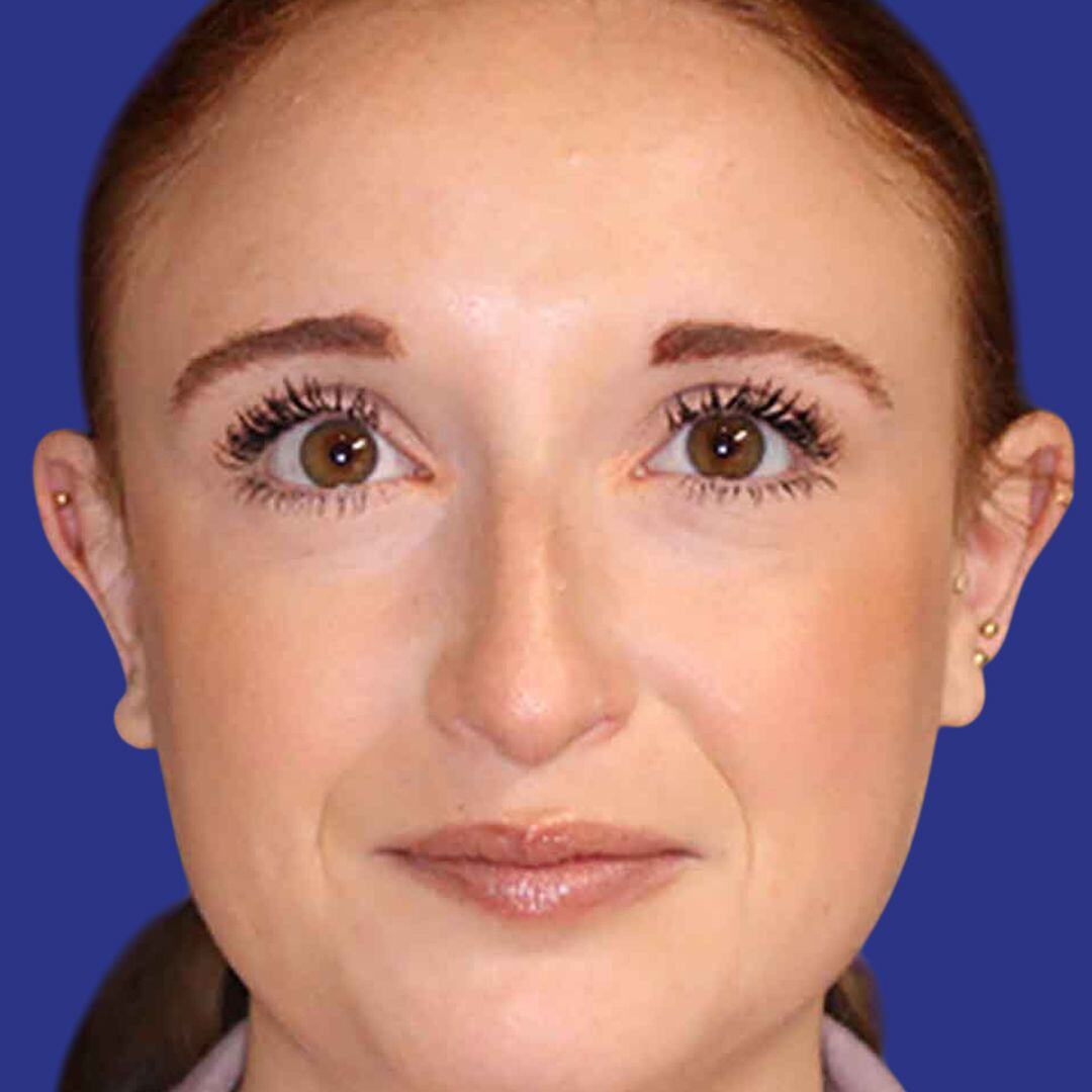 Rhinoplasty 2-Before-Front