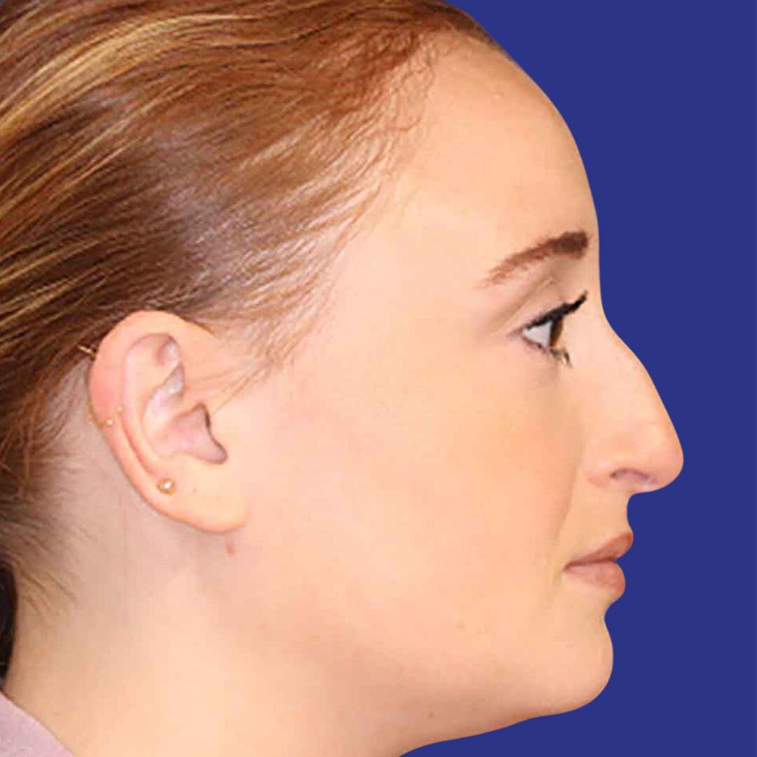 Rhinoplasty 2-Before-R-Profile