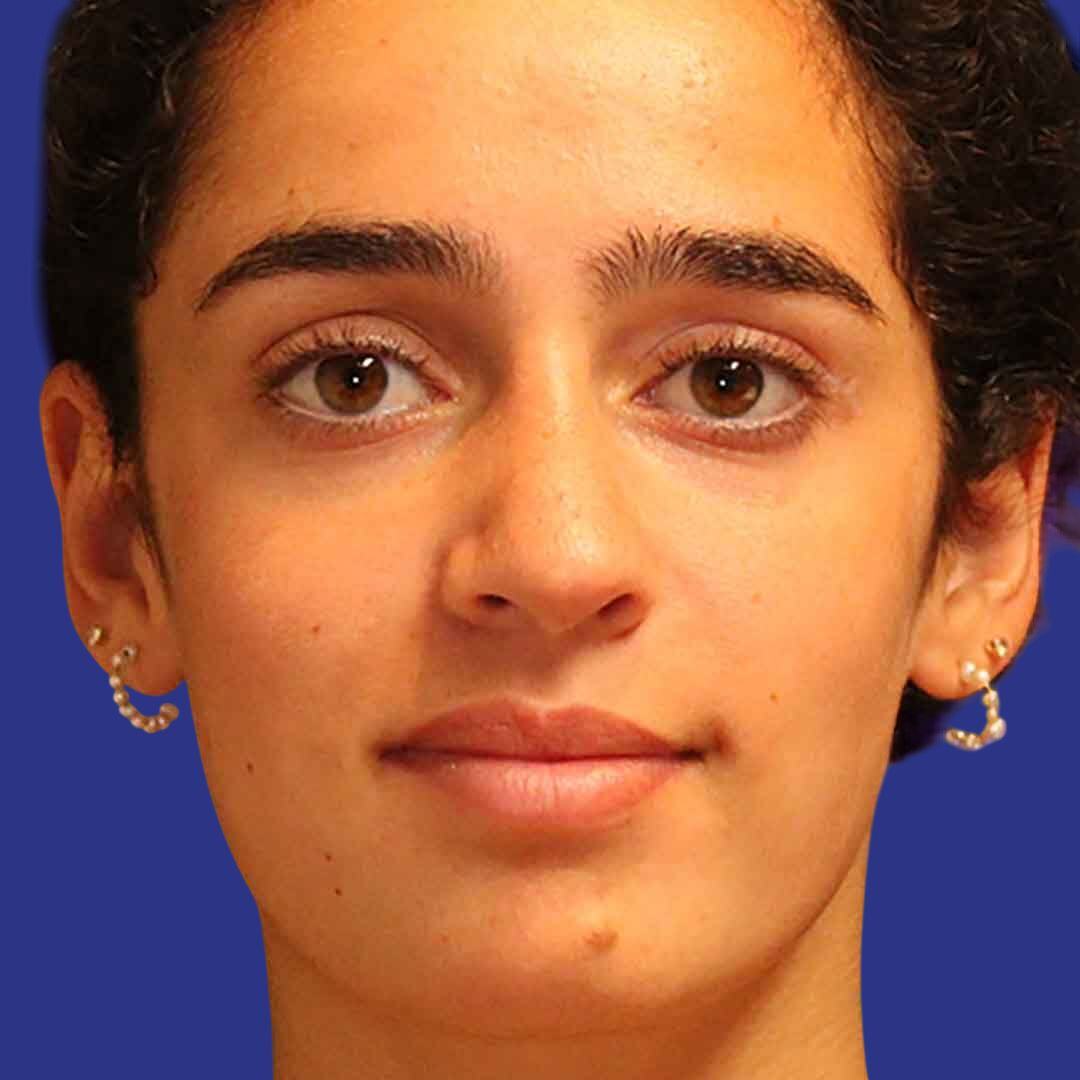 Rhinoplasty 4-After-Front