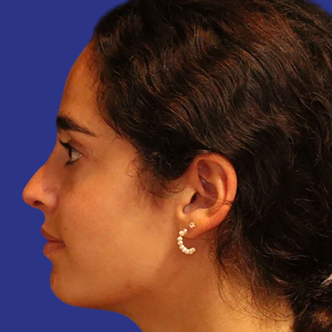 Rhinoplasty 4-After-L Proile