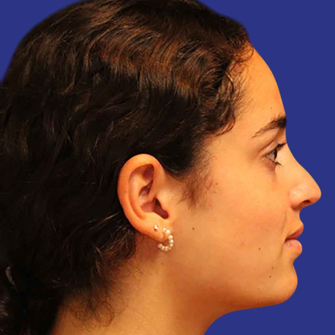 Rhinoplasty 4-After-R Proile