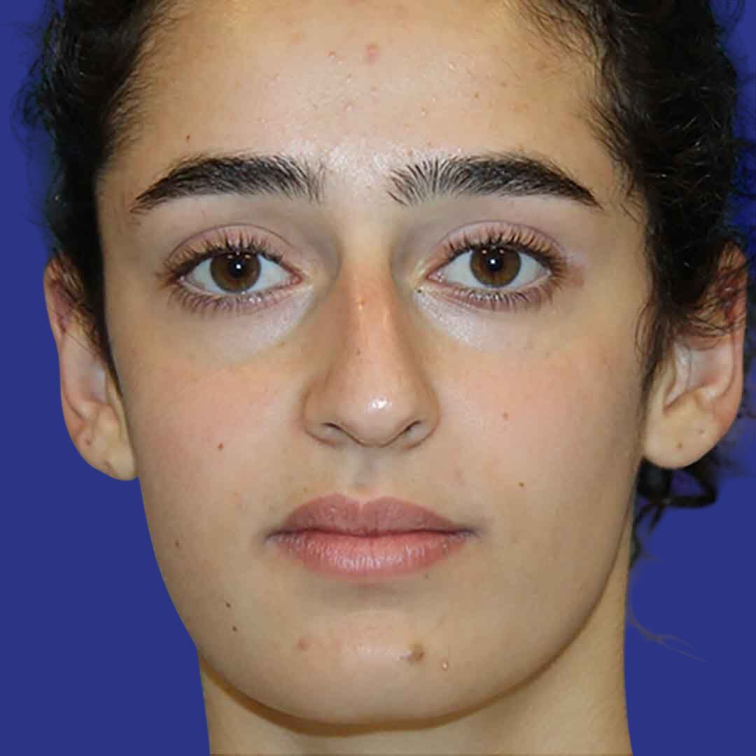 Rhinoplasty 4-Before-Front