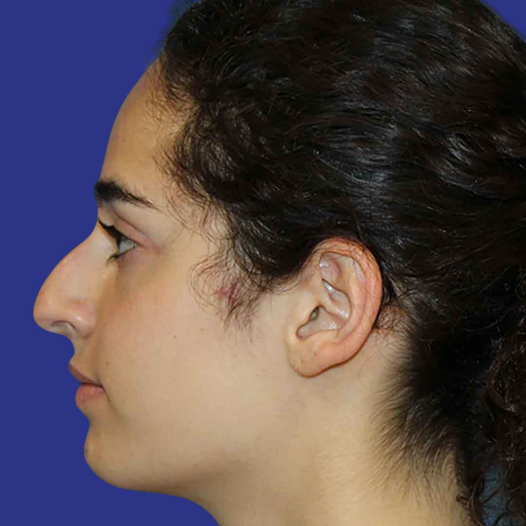 Rhinoplasty 4-Before-L Proile