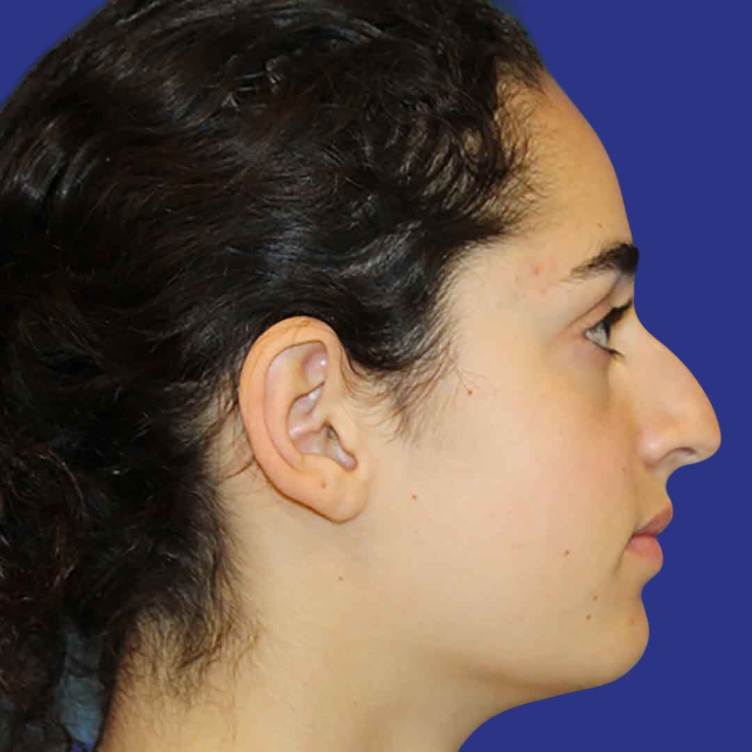 Rhinoplasty 4-Before-R Proile