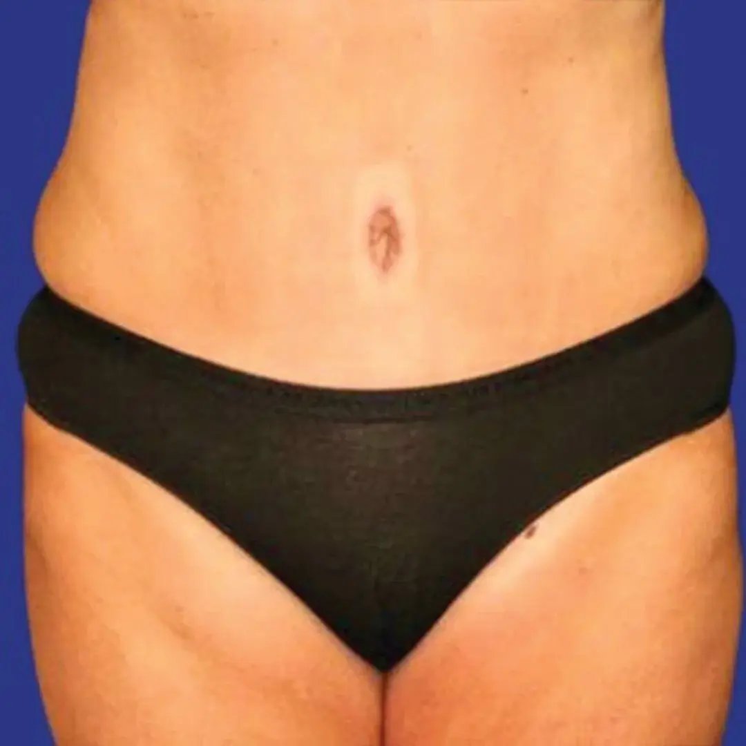 Tummy Tuck 1 Front After