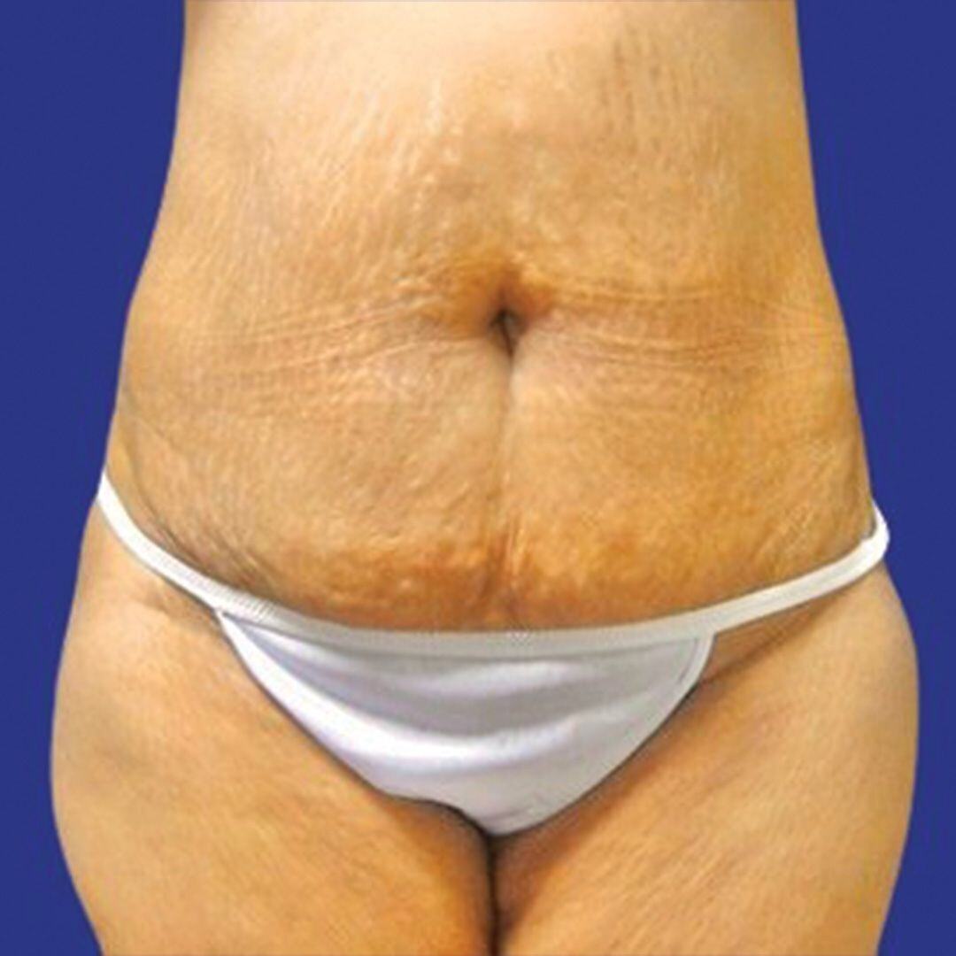 Tummy Tuck 1 Front Before-1
