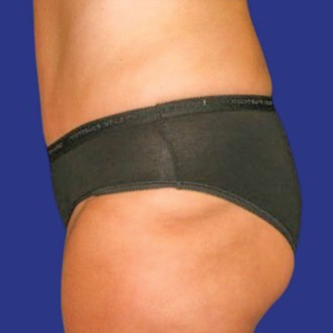 Tummy Tuck 1 Side After-1